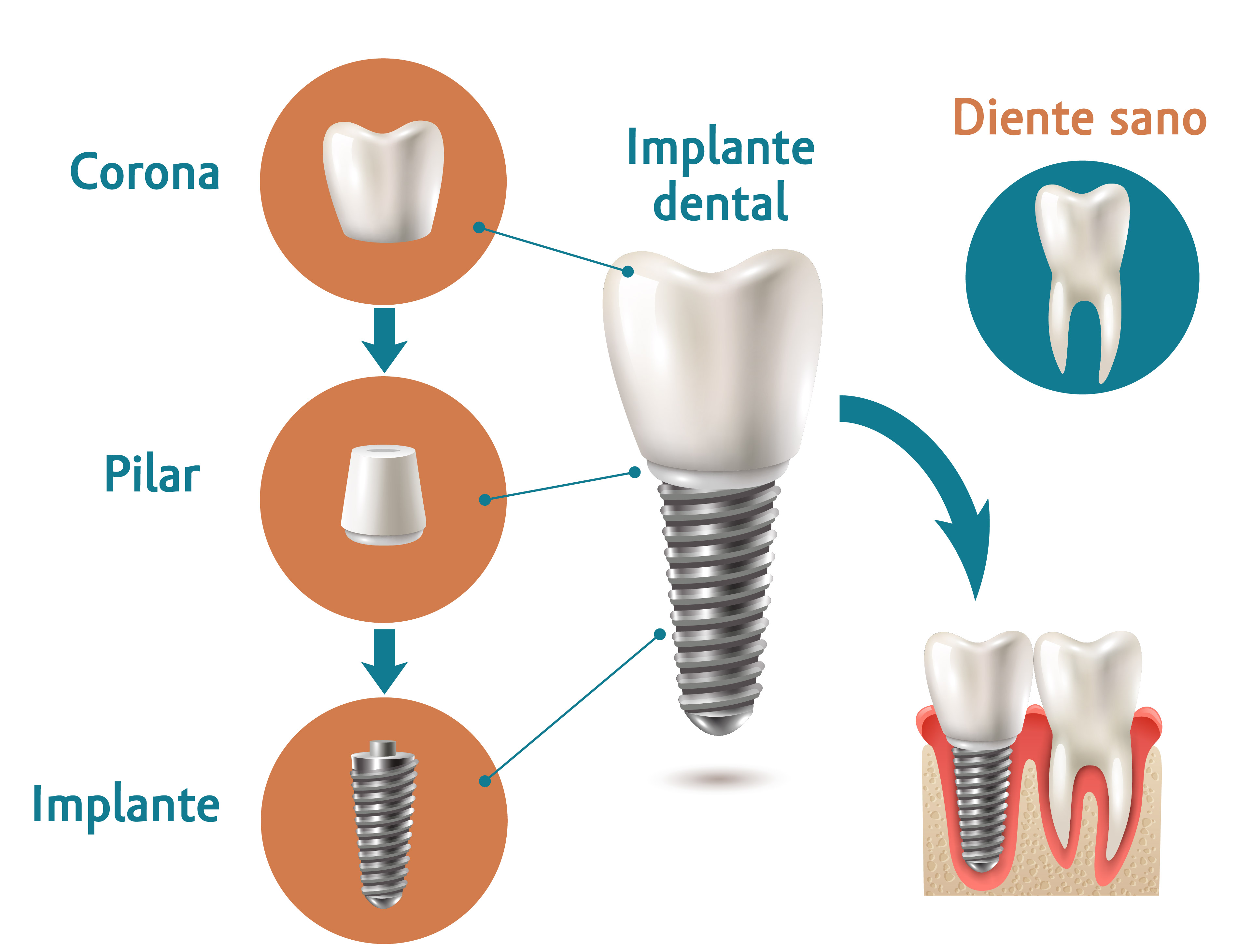 mejor-implante-dental
