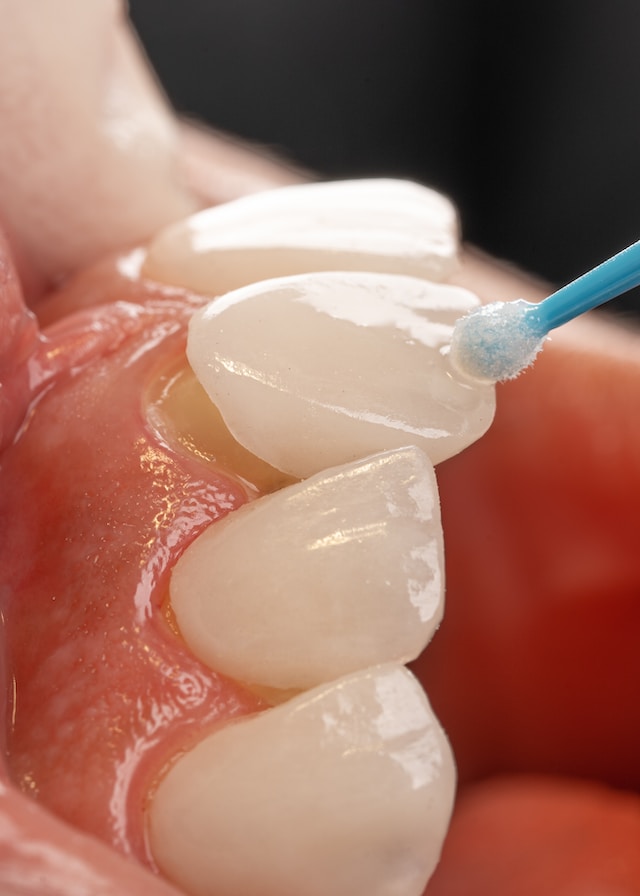 Carillas Dentales De Alta Estética (Por Diente)