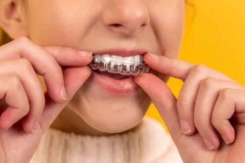 Ortodoncia Invisalign Comprehensive
