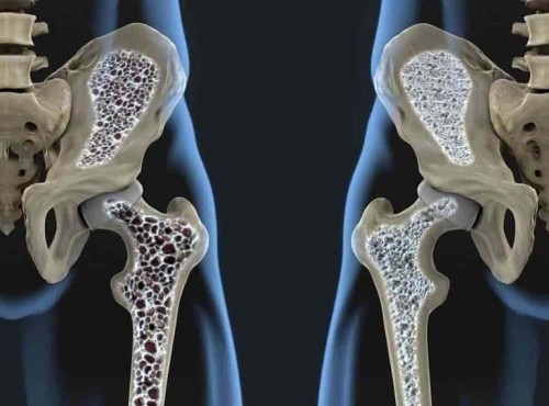Estudio Bioquímico de Osteoporosis